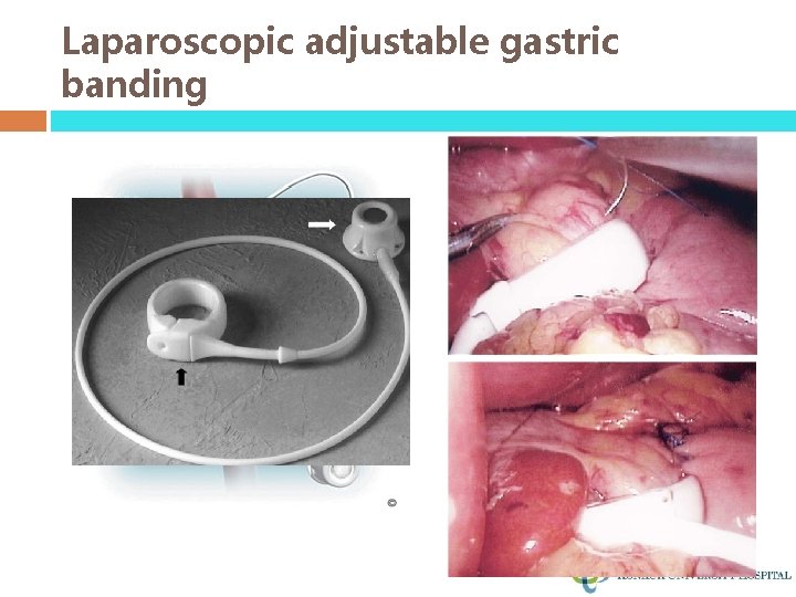 Laparoscopic adjustable gastric banding 