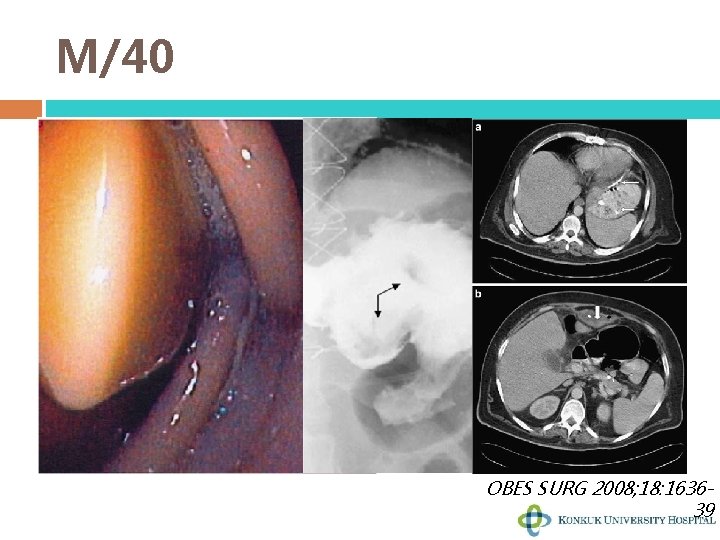 M/40 OBES SURG 2008; 18: 163639 