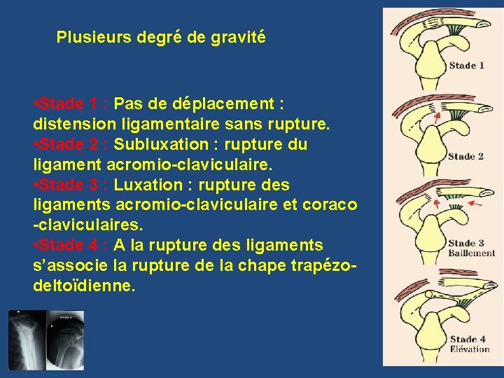 Plusieurs degré de gravité • Stade 1 : Pas de déplacement : distension ligamentaire