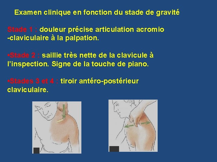 Examen clinique en fonction du stade de gravité Stade 1 : douleur précise articulation