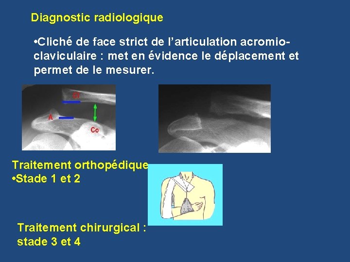 Diagnostic radiologique • Cliché de face strict de l’articulation acromioclaviculaire : met en évidence