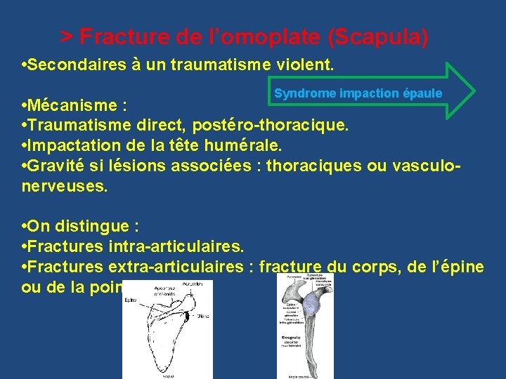 > Fracture de l’omoplate (Scapula) • Secondaires à un traumatisme violent. Syndrome impaction épaule