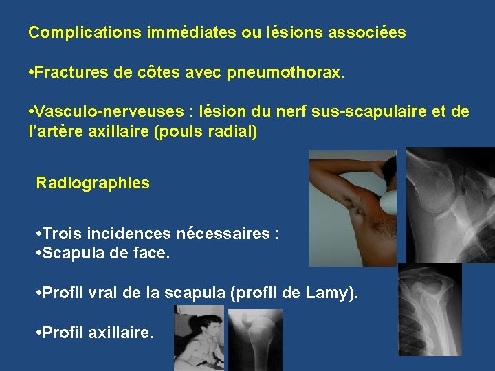 Complications immédiates ou lésions associées • Fractures de côtes avec pneumothorax. • Vasculo-nerveuses :