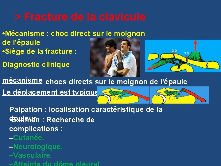 > Fracture de la clavicule • Mécanisme : choc direct sur le moignon de