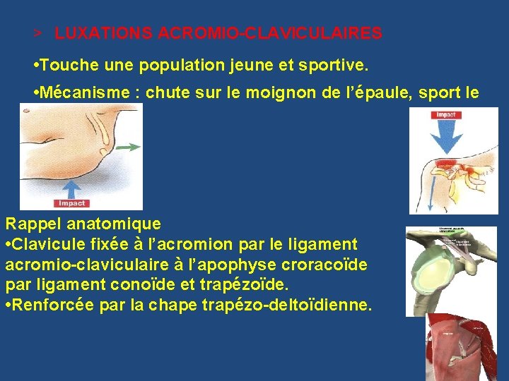 > LUXATIONS ACROMIO-CLAVICULAIRES • Touche une population jeune et sportive. • Mécanisme : chute