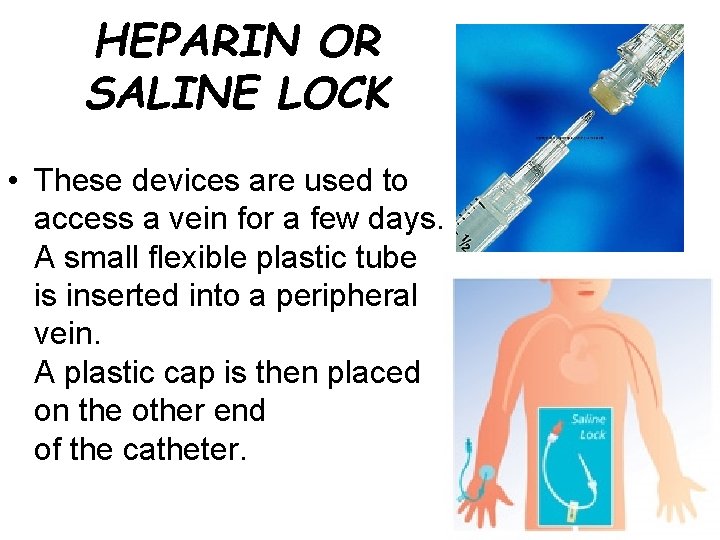HEPARIN OR SALINE LOCK • These devices are used to access a vein for