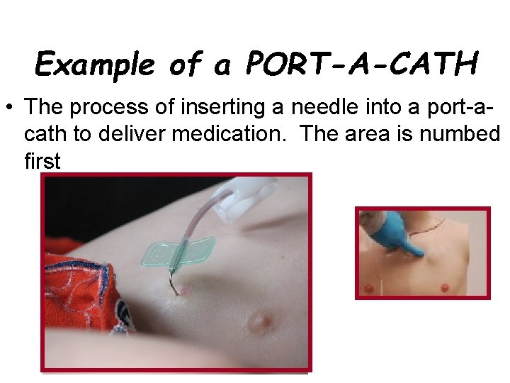 Example of a PORT-A-CATH • The process of inserting a needle into a port-acath
