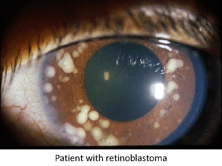 Patient with retinoblastoma 