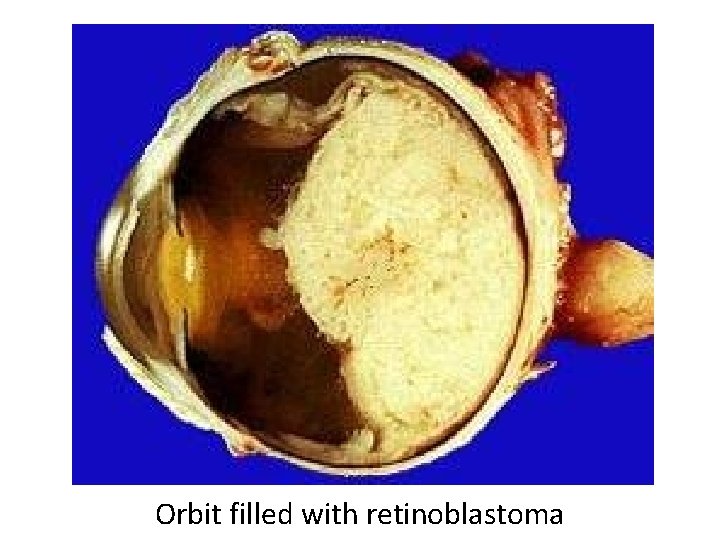 Orbit filled with retinoblastoma 