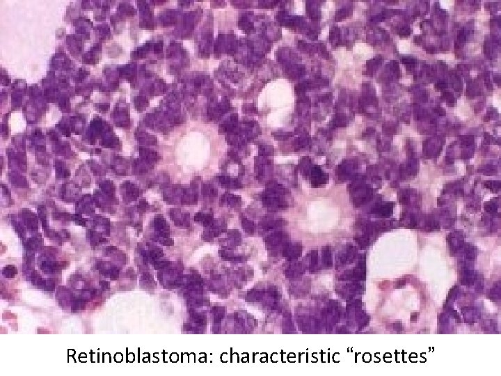 Retinoblastoma: characteristic “rosettes” 