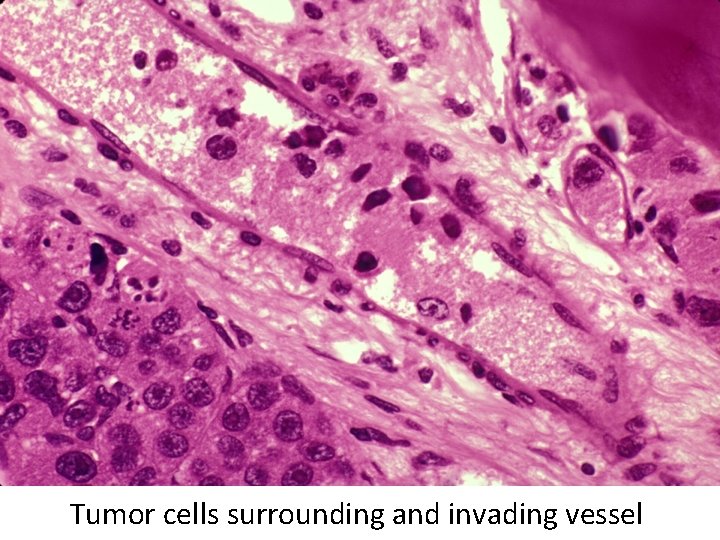 Tumor cells surrounding and invading vessel 