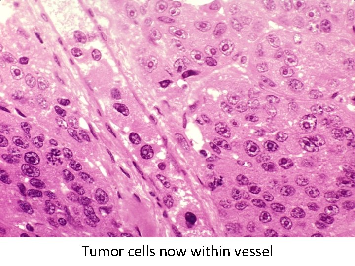 Tumor cells now within vessel 