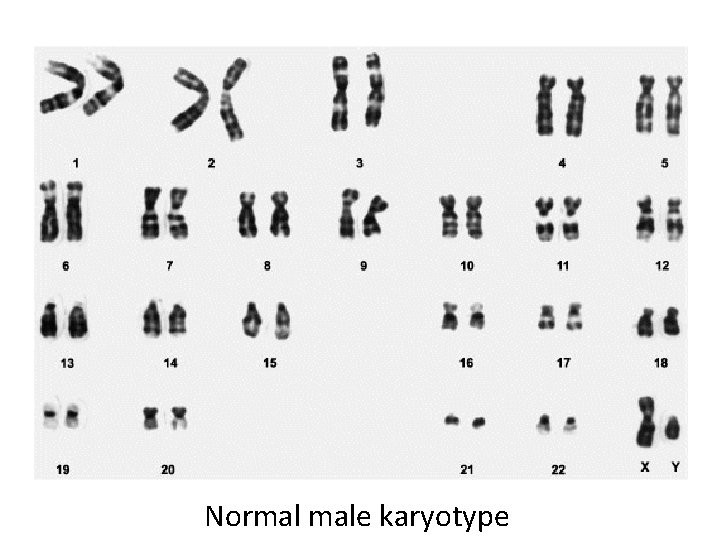 Normal male karyotype 