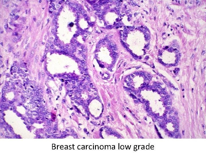 Breast carcinoma low grade 