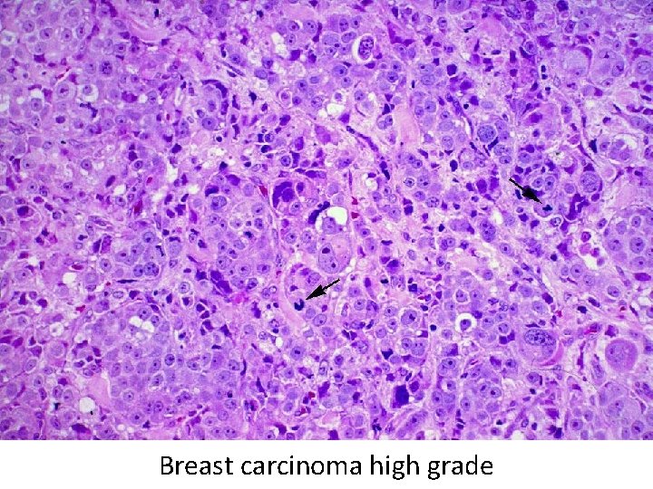 Breast carcinoma high grade 