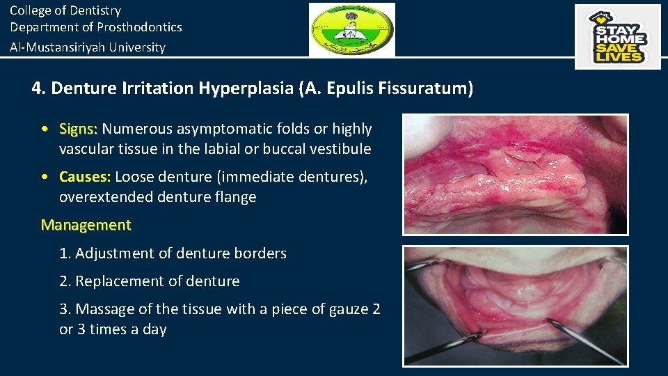 College of Dentistry Department of Prosthodontics Al-Mustansiriyah University 4. Denture Irritation Hyperplasia (A. Epulis