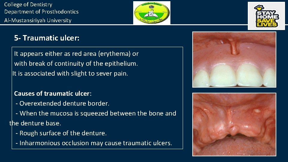 College of Dentistry Department of Prosthodontics Al-Mustansiriyah University 5 - Traumatic ulcer: It appears