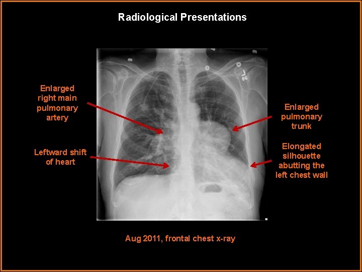 Radiological Presentations Enlarged right main pulmonary artery Enlarged pulmonary trunk Elongated silhouette abutting the