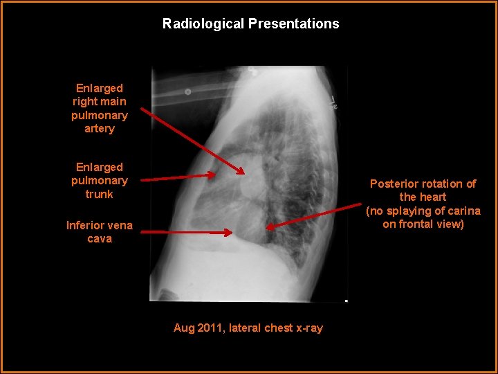Radiological Presentations Enlarged right main pulmonary artery Enlarged pulmonary trunk Posterior rotation of the