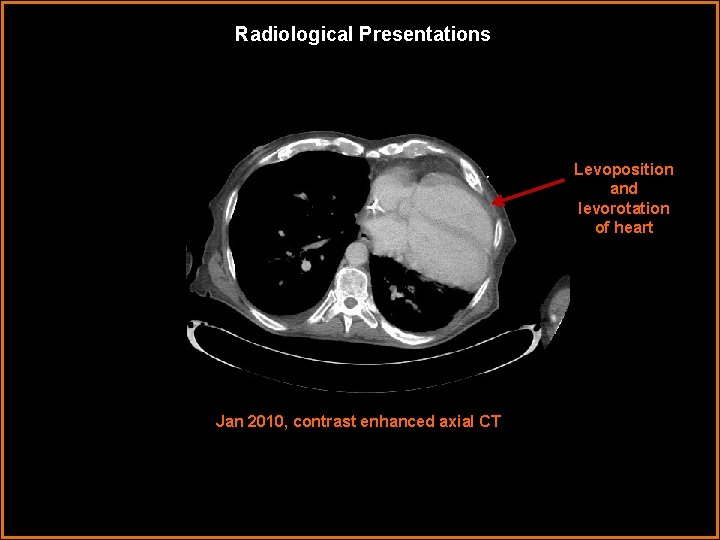 Radiological Presentations Levoposition and levorotation of heart Jan 2010, contrast enhanced axial CT 