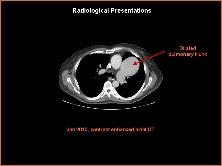 Radiological Presentations Dilated pulmonary trunk Jan 2010, contrast enhanced axial CT 