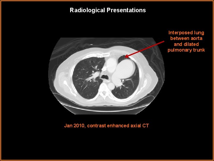 Radiological Presentations Interposed lung between aorta and dilated pulmonary trunk Jan 2010, contrast enhanced