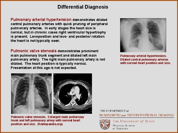 Differential Diagnosis Pulmonary arterial hypertension demonstrates dilated central pulmonary arteries with quick pruning of