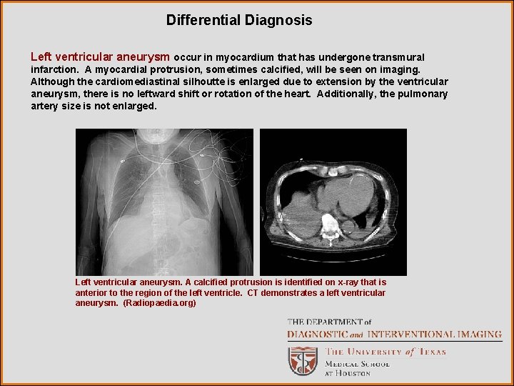 Differential Diagnosis Left ventricular aneurysm occur in myocardium that has undergone transmural infarction. A