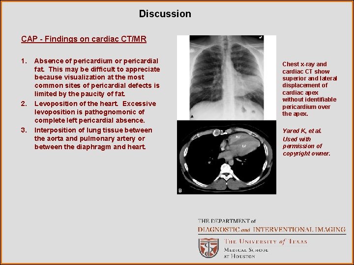 Discussion CAP - Findings on cardiac CT/MR 1. 2. 3. Absence of pericardium or