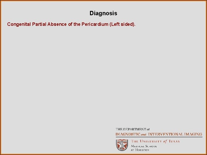 Diagnosis Congenital Partial Absence of the Pericardium (Left sided). 