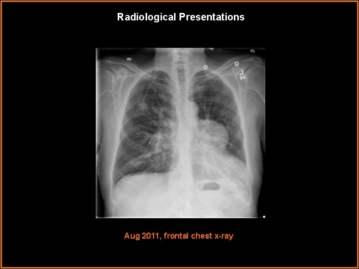 Radiological Presentations Aug 2011, frontal chest x-ray 