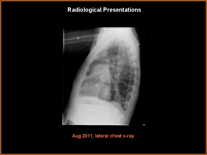 Radiological Presentations Aug 2011, lateral chest x-ray 