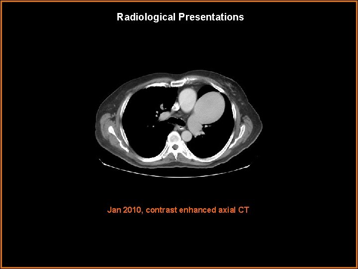 Radiological Presentations Jan 2010, contrast enhanced axial CT 