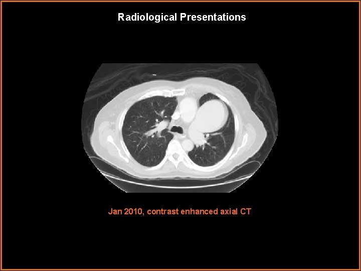 Radiological Presentations Jan 2010, contrast enhanced axial CT 