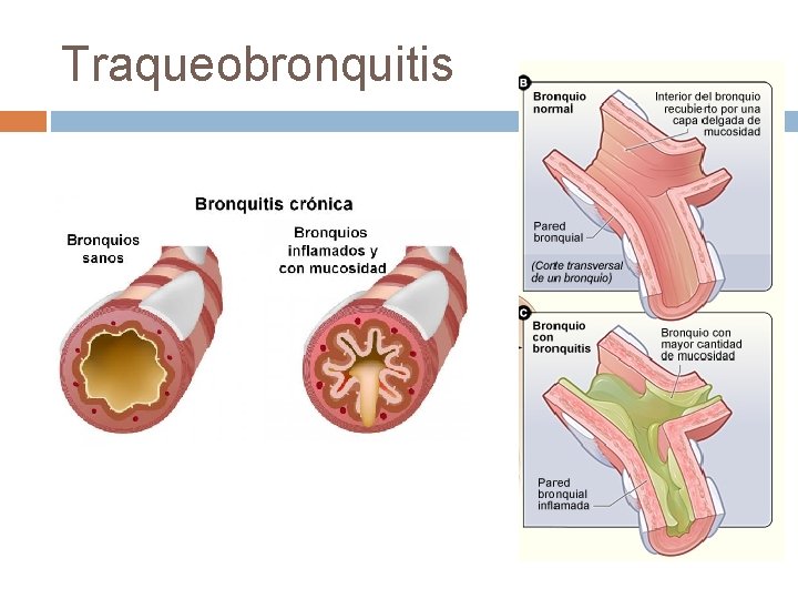 Traqueobronquitis 