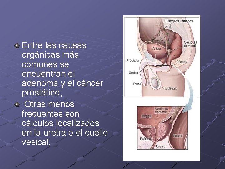 Entre las causas orgánicas más comunes se encuentran el adenoma y el cáncer prostático;