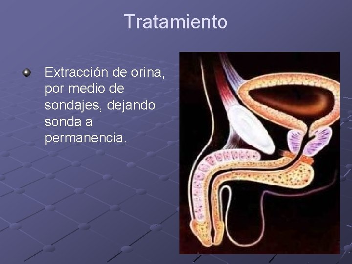 Tratamiento Extracción de orina, por medio de sondajes, dejando sonda a permanencia. 