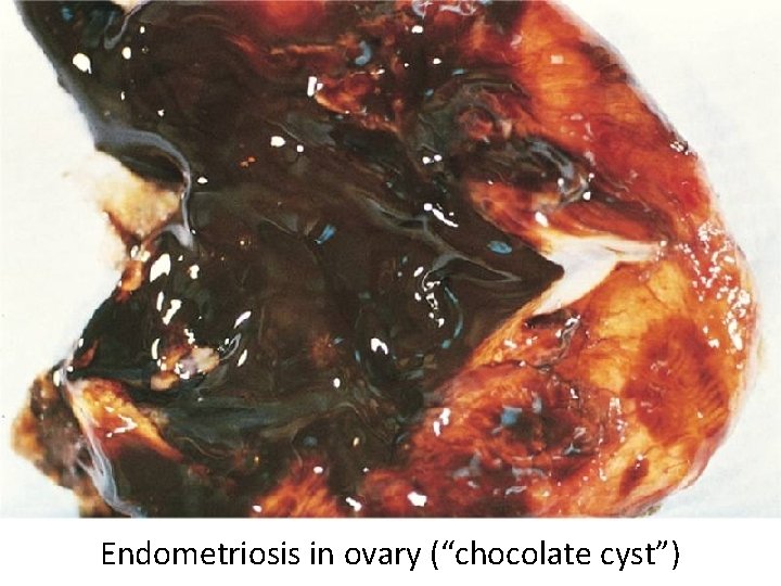 Endometriosis in ovary (“chocolate cyst”) 