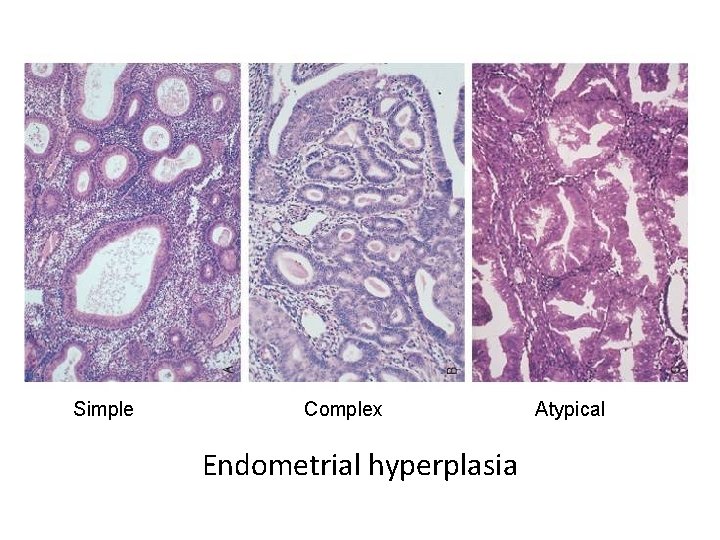 Simple Complex Endometrial hyperplasia Atypical 