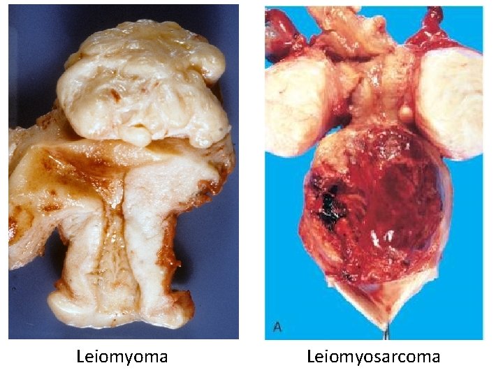 Leiomyoma Leiomyosarcoma 