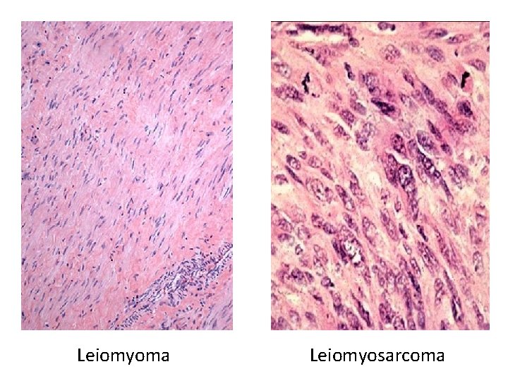 Leiomyoma Leiomyosarcoma 