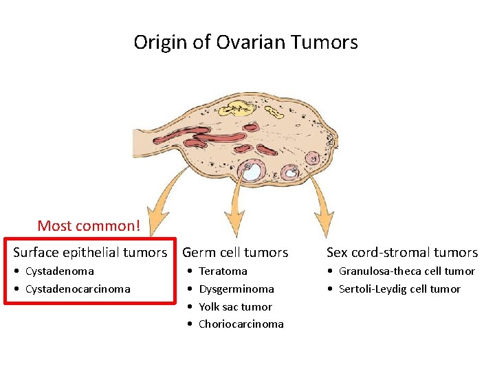 Origin of Ovarian Tumors Most common! Surface epithelial tumors Germ cell tumors Sex cord-stromal