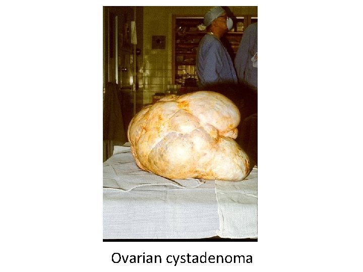 Ovarian cystadenoma 