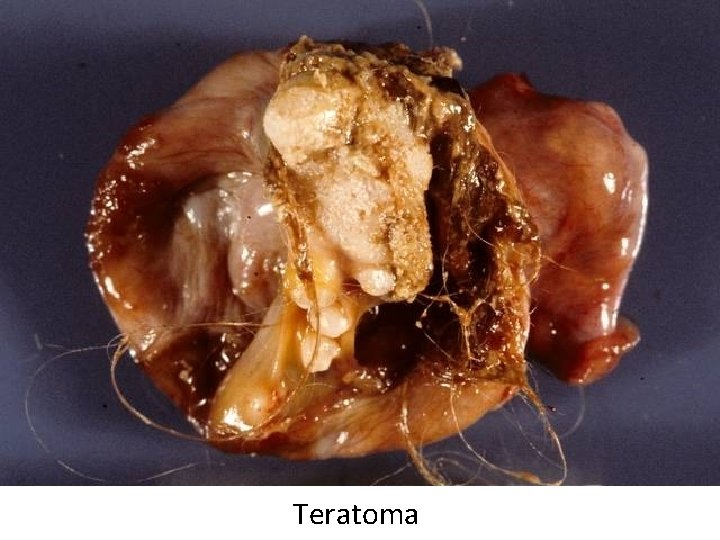 Teratoma 