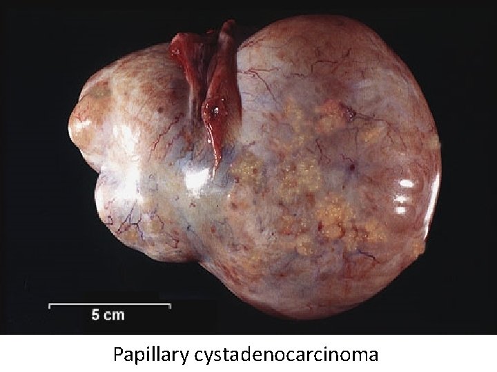 Papillary cystadenocarcinoma 