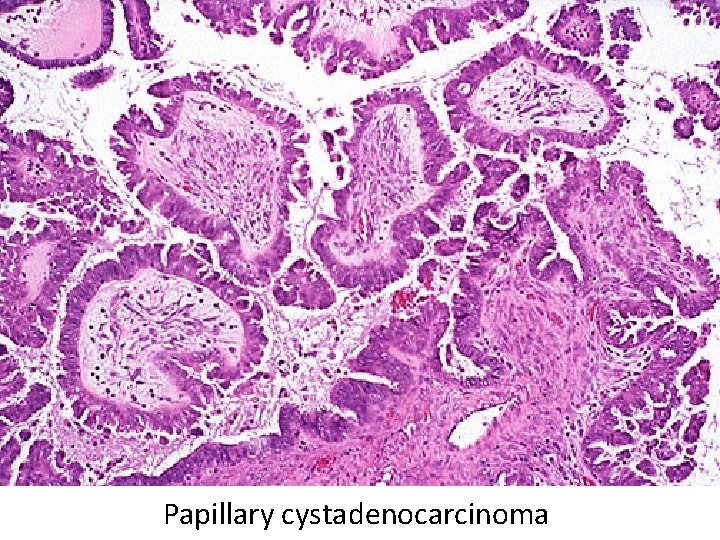 Papillary cystadenocarcinoma 