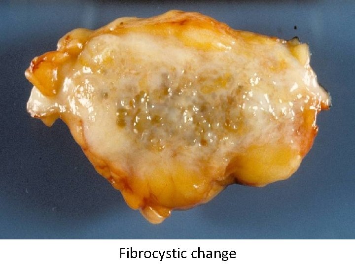 Fibrocystic change 