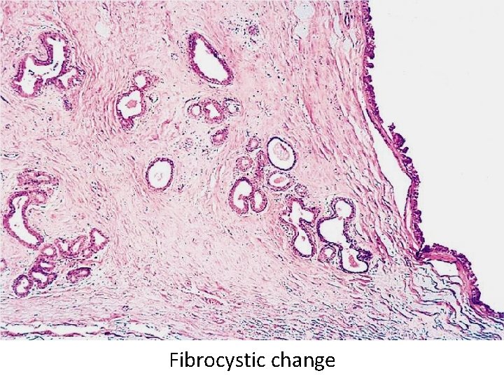 Fibrocystic change 