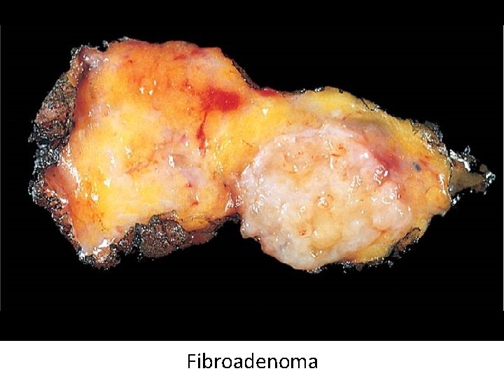 Fibroadenoma 
