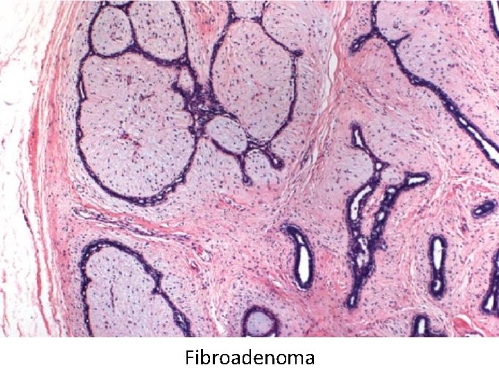 Fibroadenoma 